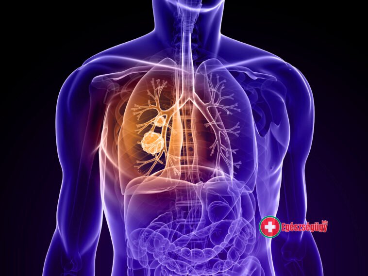 Lélegezzen könnyebben! - mit tegyen, ha COPD betegsége van?