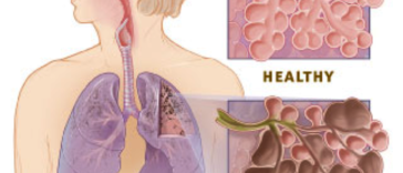 Több a fel nem ismert COPD beteg a közép-kelet-európai régióban