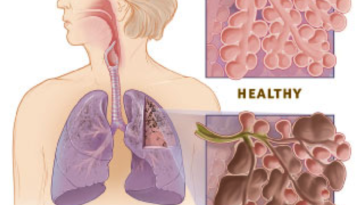 Több a fel nem ismert COPD beteg a közép-kelet-európai régióban