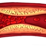 Értisztító módszer, ami leoldja a plakkokat az érfalról