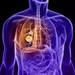 Lélegezzen könnyebben! - mit tegyen, ha COPD betegsége van?