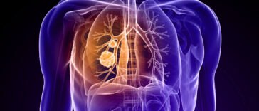 Lélegezzen könnyebben! - mit tegyen, ha COPD betegsége van?