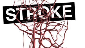 Korszakalkotó vizsgálati eredmények: jobb gyógyulási esélyek stroke illetve vénás thromboembolia után