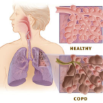 Több a fel nem ismert COPD beteg a közép-kelet-európai régióban