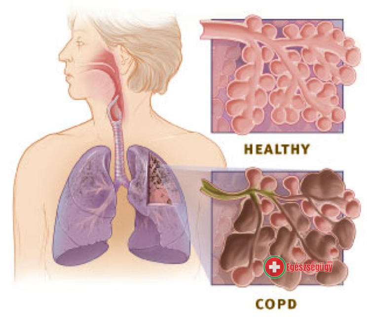 Több a fel nem ismert COPD beteg a közép-kelet-európai régióban