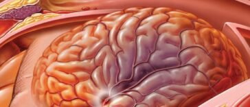 Tudatosan a stroke ellen