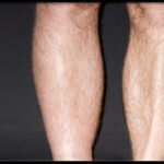 Biztos benne, hogy csak a melegtől duzzad a lába?