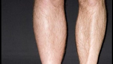 Biztos benne, hogy csak a melegtől duzzad a lába?