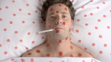 Ausztriában idén már 85 kanyarós esetet regisztráltak