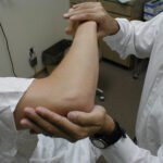 Intenzív fizikoterápiával visszahozhatók a szélütés után a felső végtag funkciói