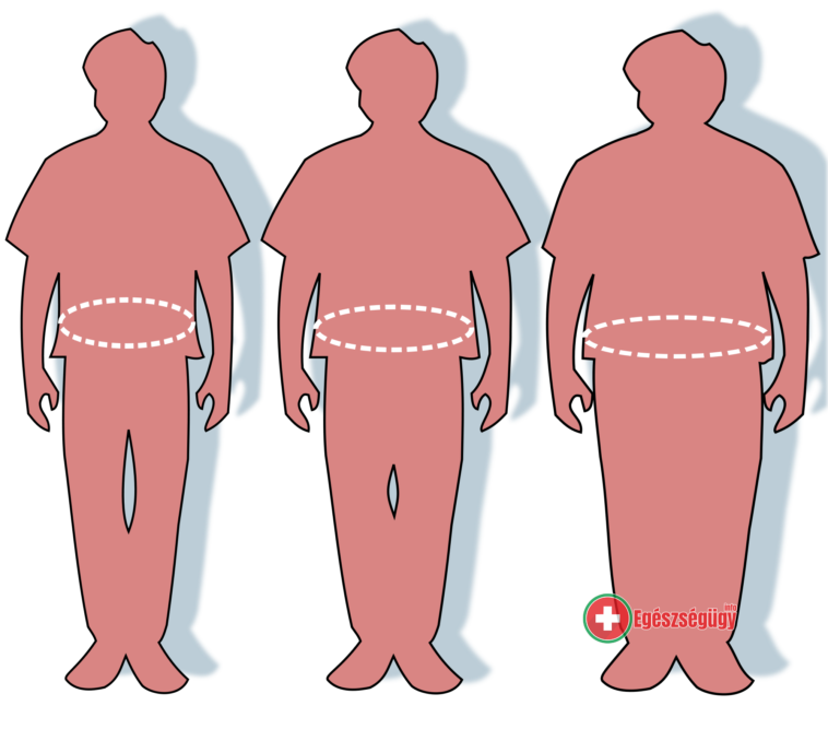 Obezitológia. Nem ismerős? Elhízástudomány! Érdekes téma!