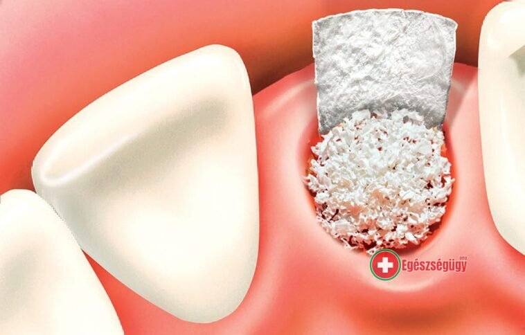 Fogászati csontpótlás, mint rutineljárás