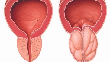 prosztatadaganatos 1