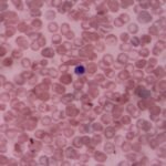 Őssejt-terápia lehet a koronavírus egyik gyógymódja? 15 Őssejt-terápia lehet a koronavírus egyik gyógymódja?