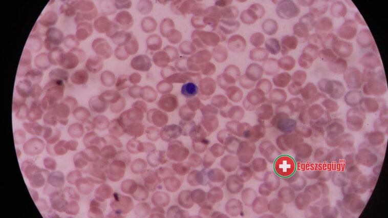 Őssejt-terápia lehet a koronavírus egyik gyógymódja?