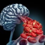 Egyre több a stroke a diagnosztizált koronavírusos eseteknél