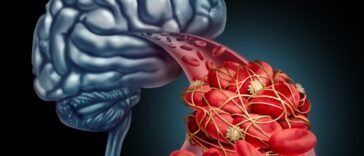 Egyre több a stroke a diagnosztizált koronavírusos eseteknél