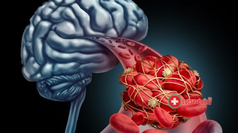 Egyre több a stroke a diagnosztizált koronavírusos eseteknél