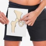 A csípőízületi kopás fiatalkorban is kialakulhat!