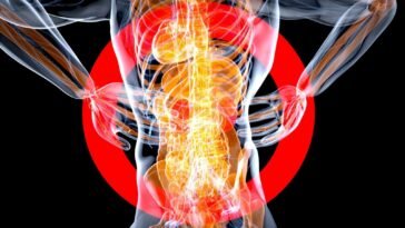 fibromyalgia szindróma