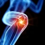 Térdprotézis és csípőprotézis: mikor jön el az ideje? 18 Térdprotézis és csípőprotézis: mikor jön el az ideje?